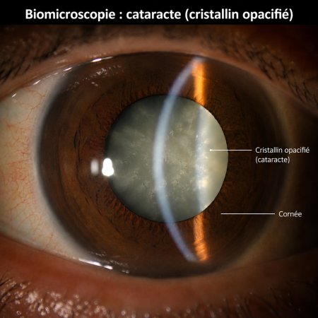 Cataracte : symptômes, causes et solutions pour retrouver une vision plus claire